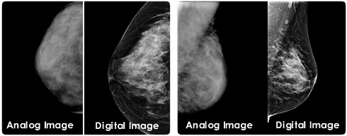 Diagnostic Digital Mammography